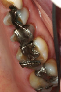 Before shot of silver fillings Before shot of silver fillings