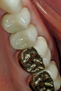 Four PFM crowns