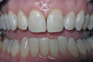 Close up shot of a patient with a gap between her two front teeth