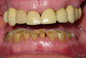 Worn Lower Teeth - Before Close up shot of teeth before restoration