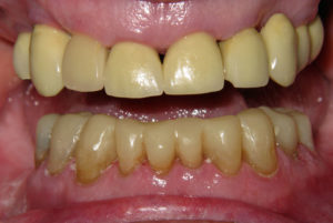 Restoration of Worn Lower Teeth Restoration of Worn Lower Teeth