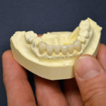 6 all ceramic crowns of lower teeth shown on a stone cast