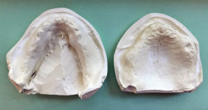 photo of denture casts made by Dr. Albers from impressions
