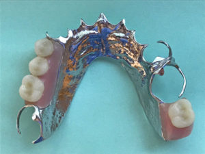 A cast partial denture using metal and acrylic