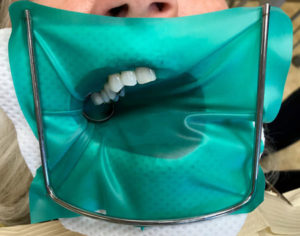 A patient with a rubber dam isolating their teeth