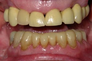 Restoration of Worn Lower Teeth