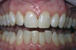 Teeth With Gap - After