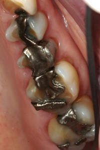 Before shot of silver fillings
